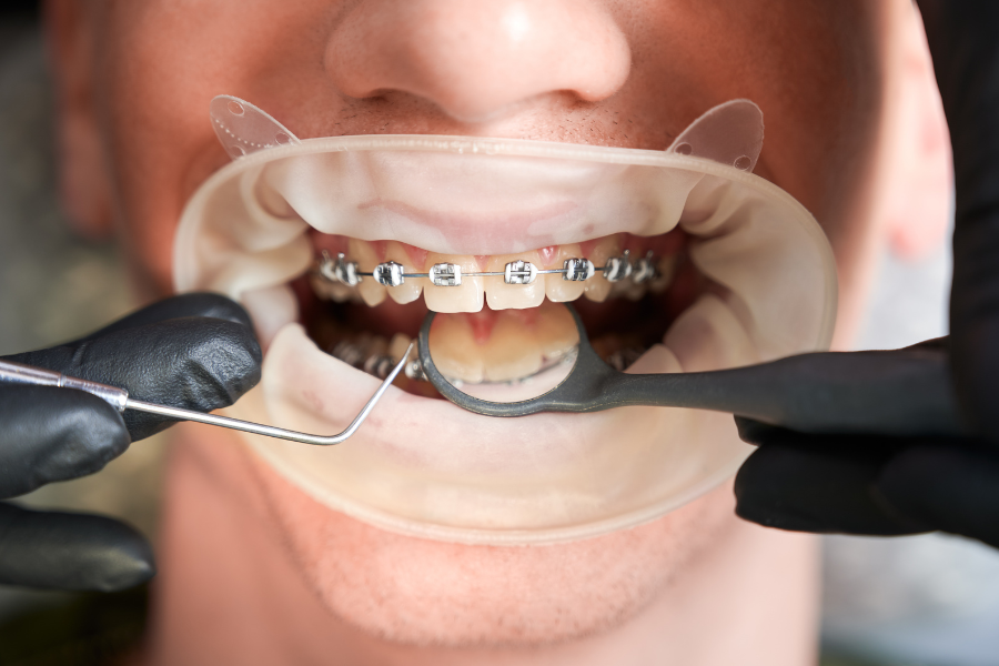 behel damon vs metal