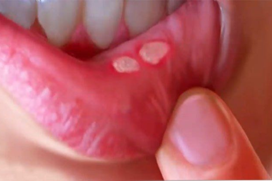 sariawan berulang dan luka kronis