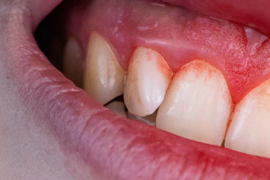 penyebab gusi berdarah saat puasa