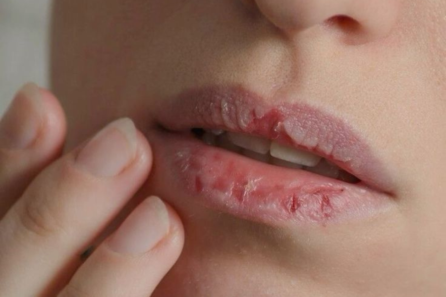 cara atasi mulut kering