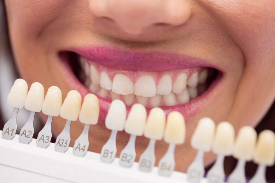 veneer gigi surabaya