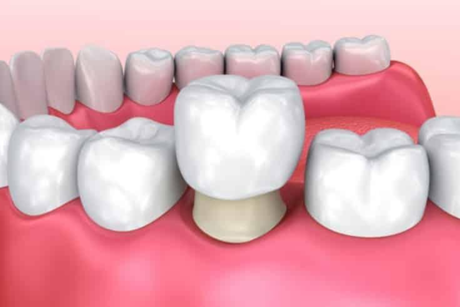 implant dan crown gigi