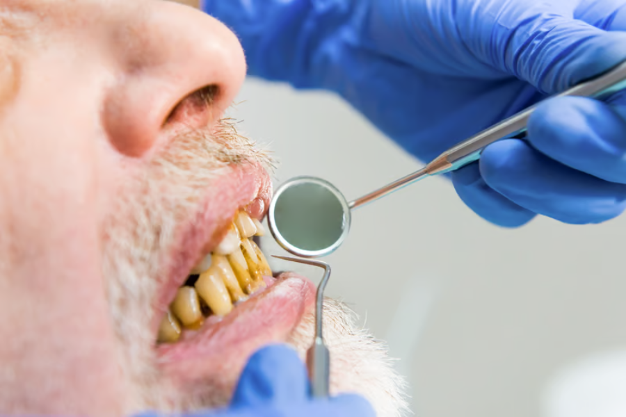 penyebab gigi kuning yang berkaitan dengan kondisi enamel dan dentin